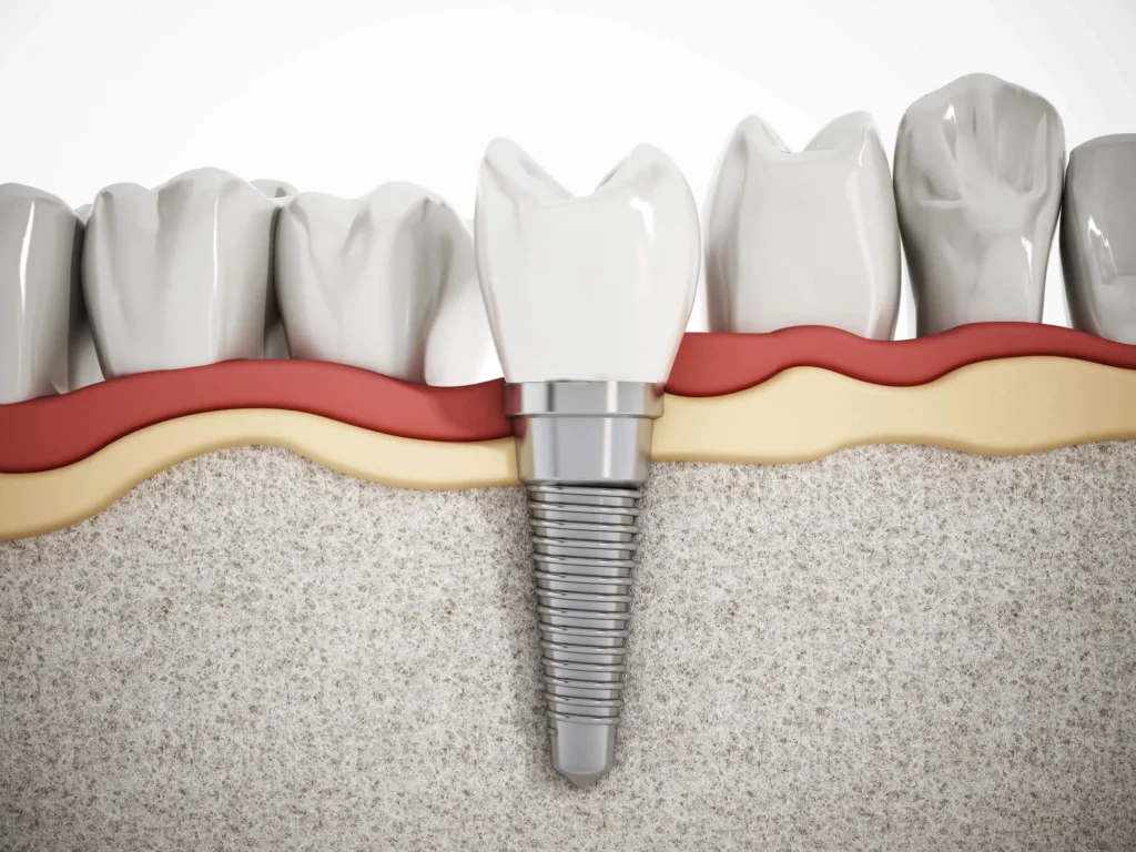 Illustration showing dental implants in Franklinville, NJ