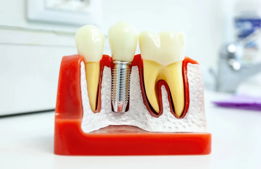 Dental implant model showing options for dental implants in Franklinville NJ